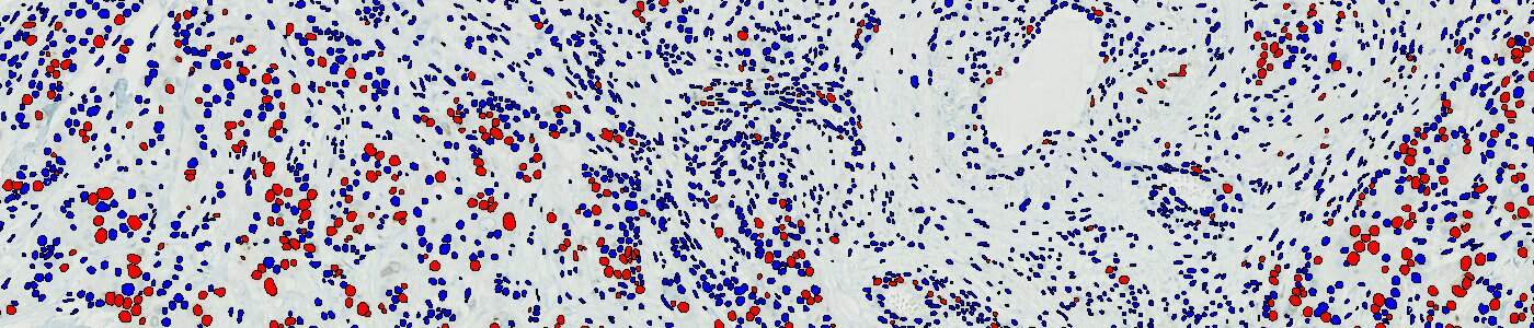 Nuclei DAB Quantification