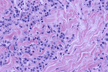 H&E, Tumor Detection