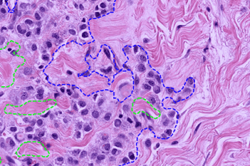 H&E, Tumor Detection