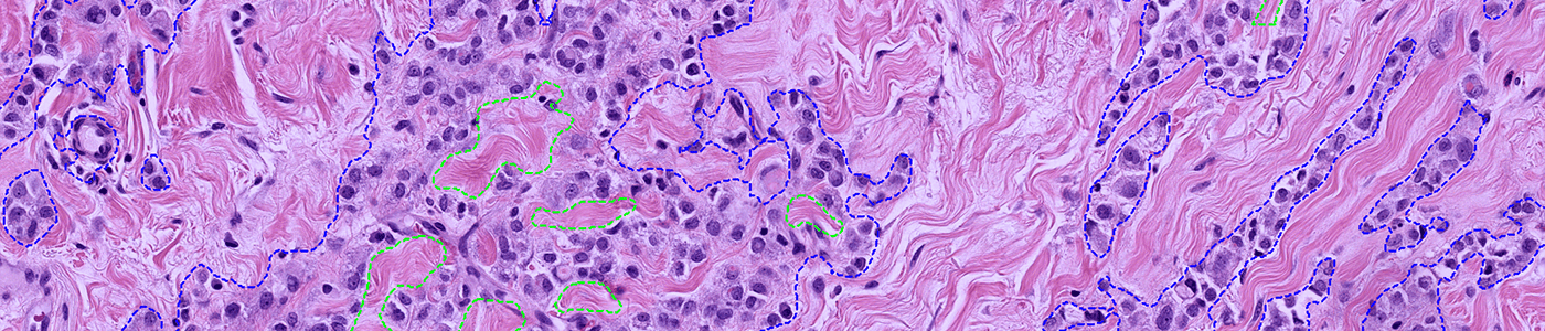 H&E, Tumor Detection