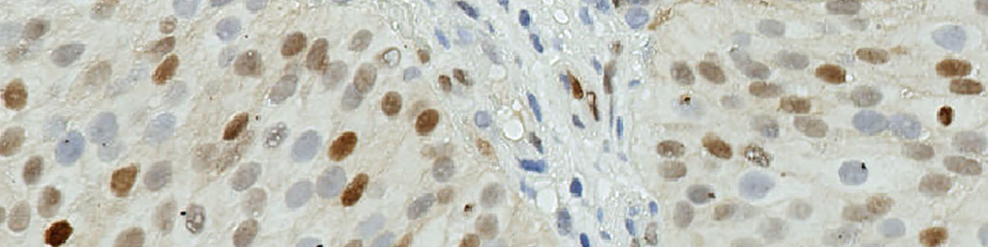 CyclinD1, Bladder Cancer