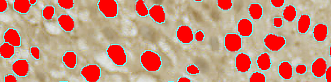 Annexin 10, Bladder Cancer