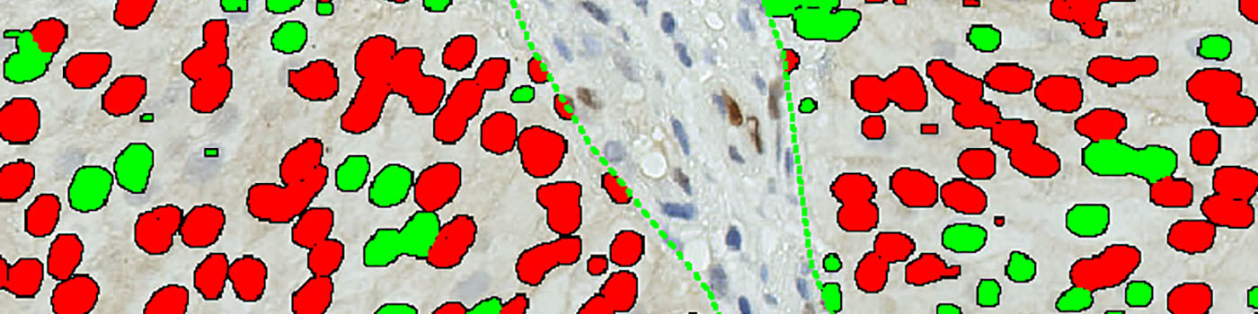 CyclinD1, Bladder Cancer