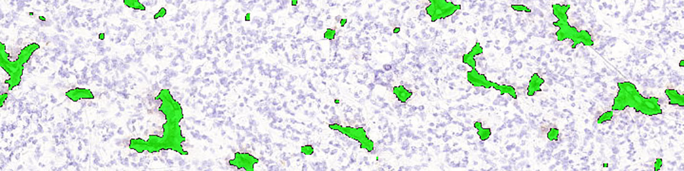 CD31, Tumor Neovascularization