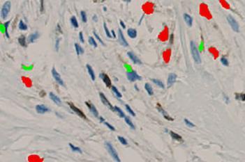 5LO, Arteriosclerosis