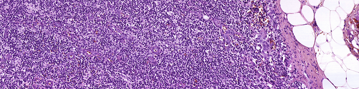 Metastasis Detection, AI