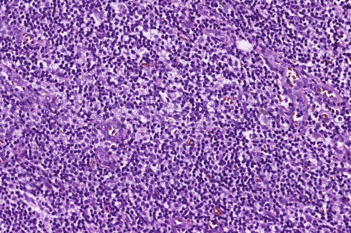 Metastasis Detection, AI