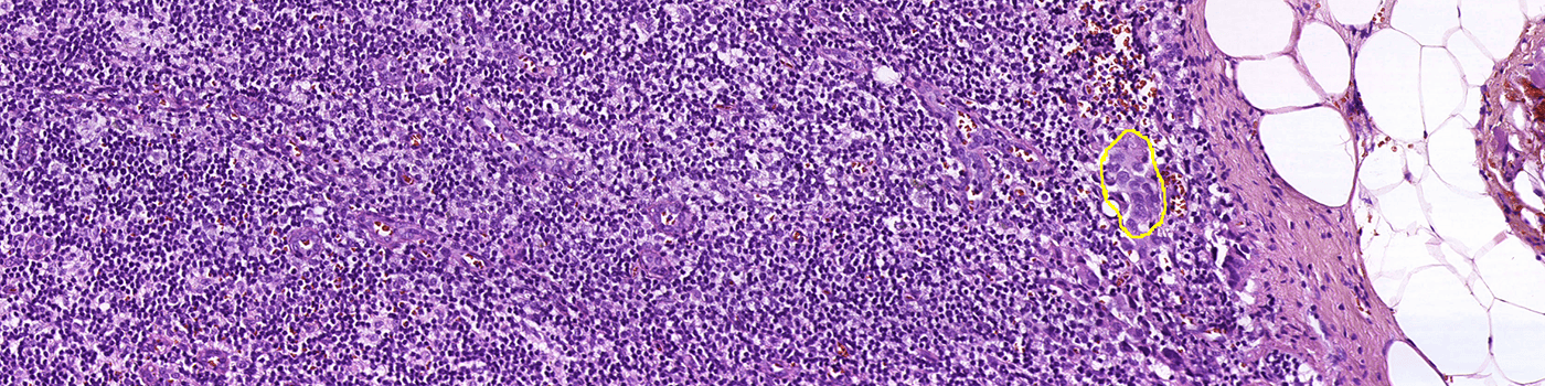 Metastasis Detection, AI