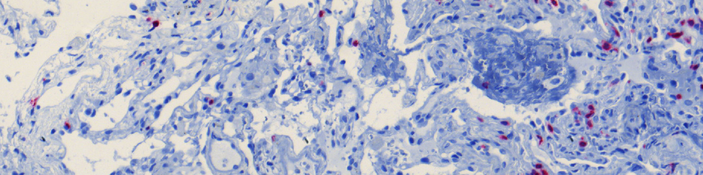 CD3, Lung Transplantation