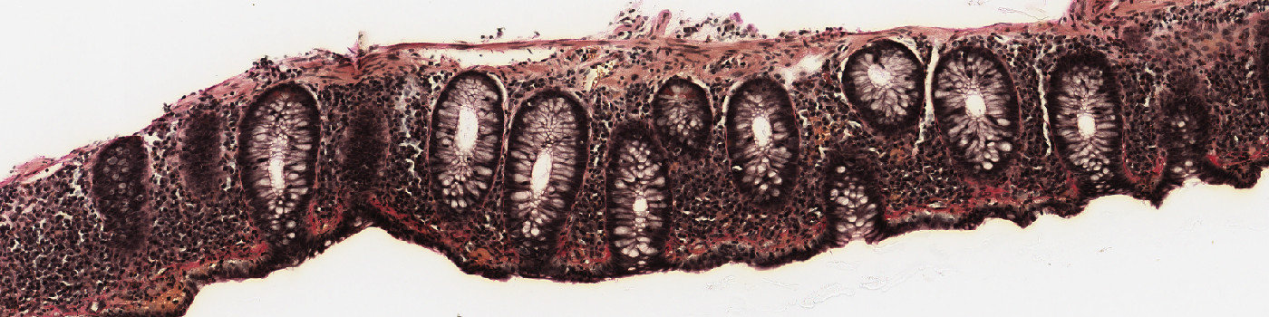 Van Gieson, Collagenous Colitis