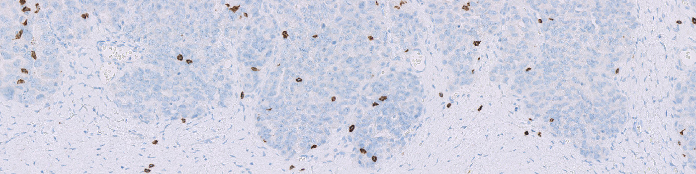 CD8, Ovarian Cancer, TME