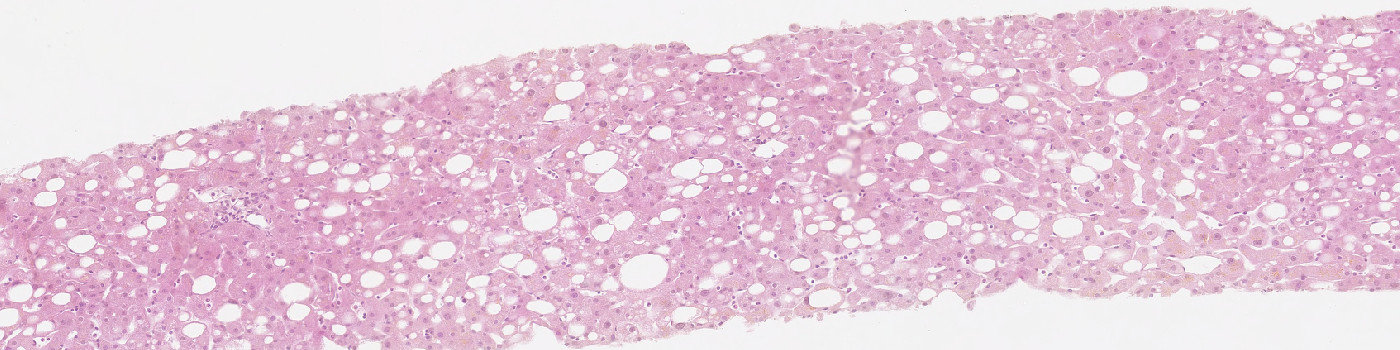 H&E, Liver Steatosis