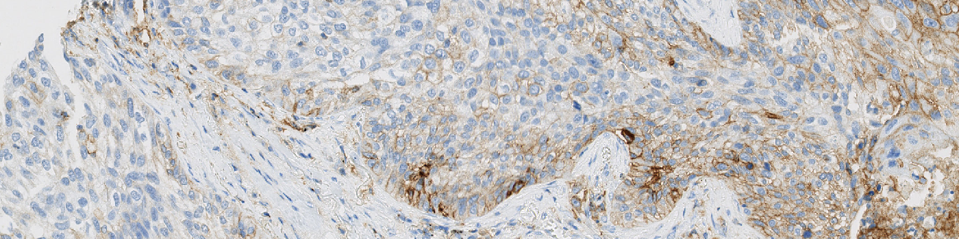 PD-L1, Melanoma, TME