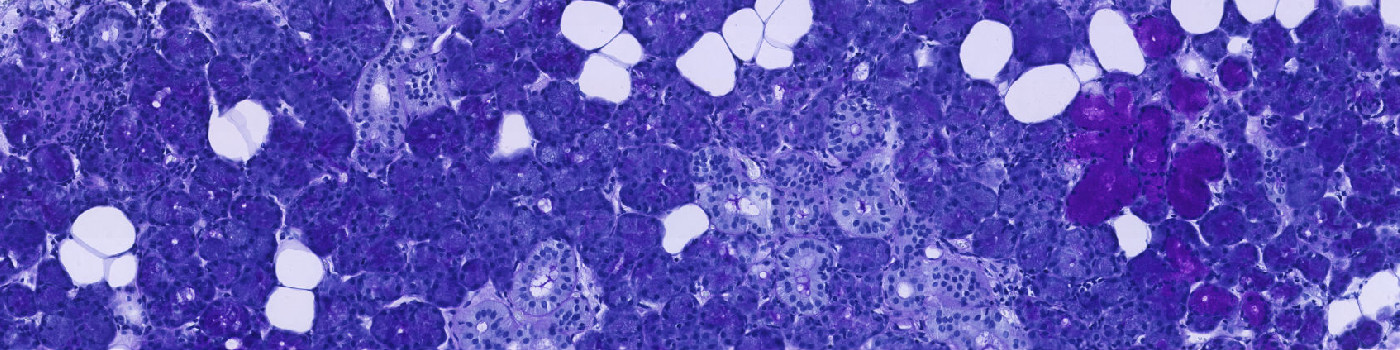 PAS + PCK (VDS), Salivary Gland Tumor