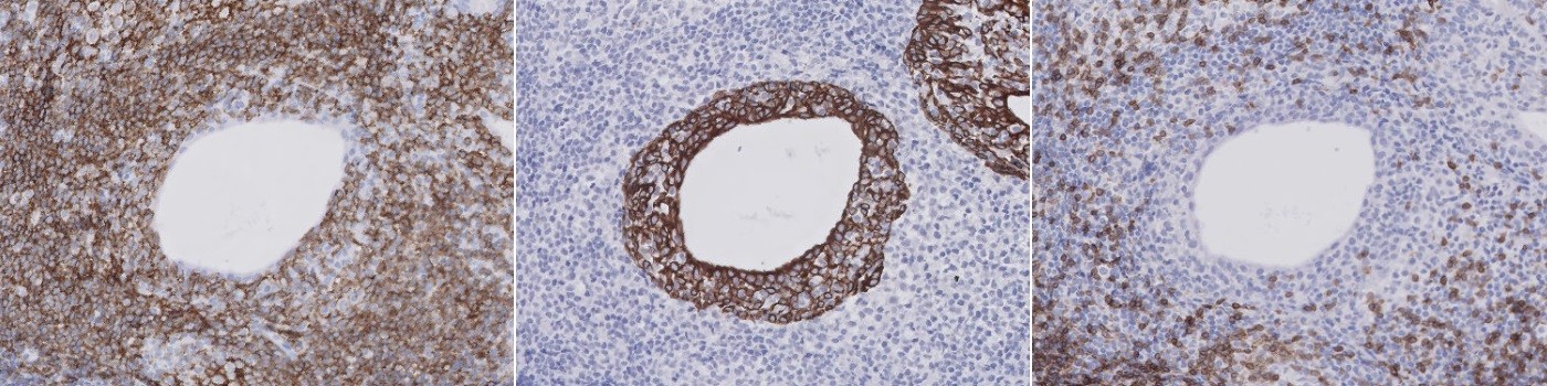 CD3+CD20+CK, Sjögren’s Syndrome