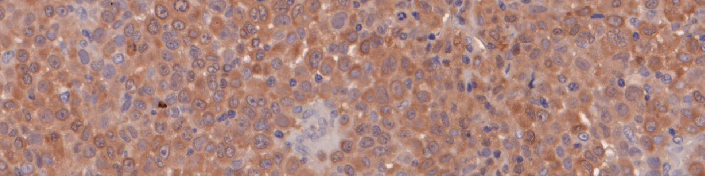 MIF, Melanoma, TME