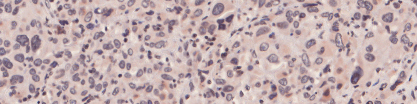 iNOS, Melanoma, TME