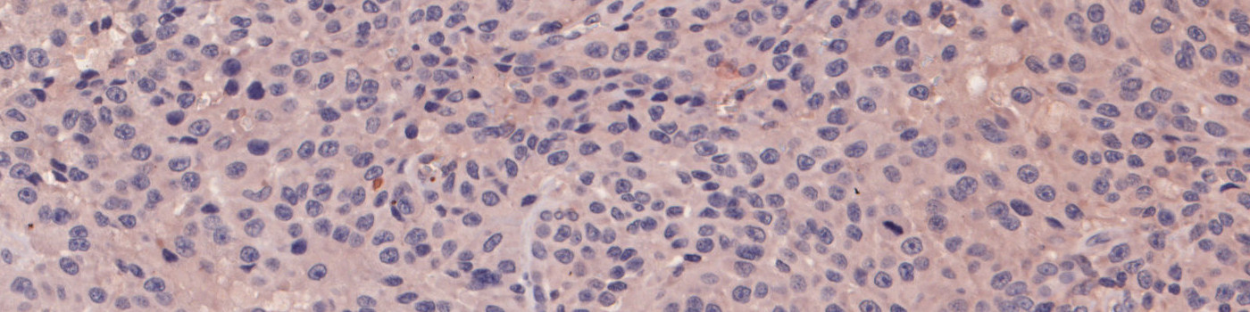 NT, Melanoma, TME