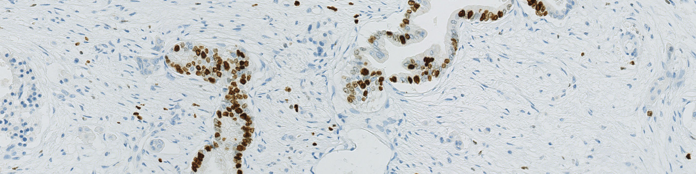 Ki-67, Pancreatic Cancer