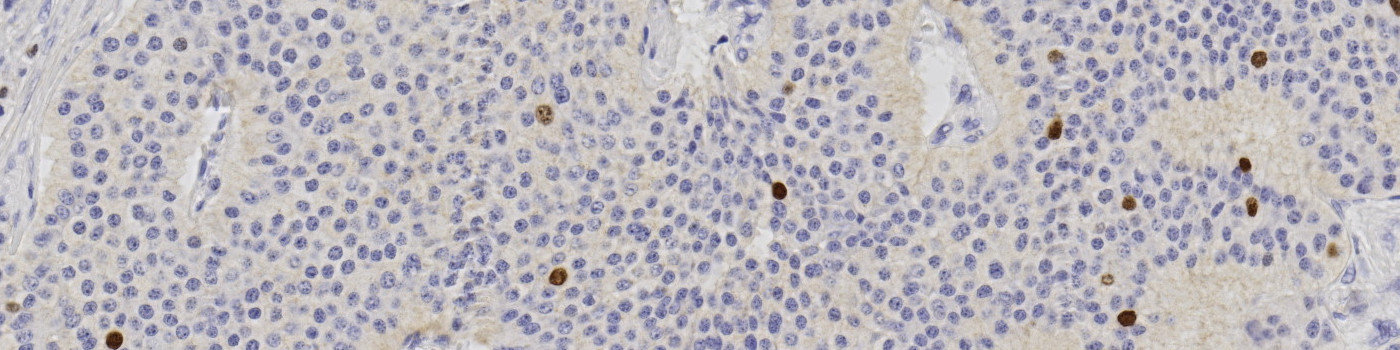 Ki-67, Neuroendocrine Neoplasm