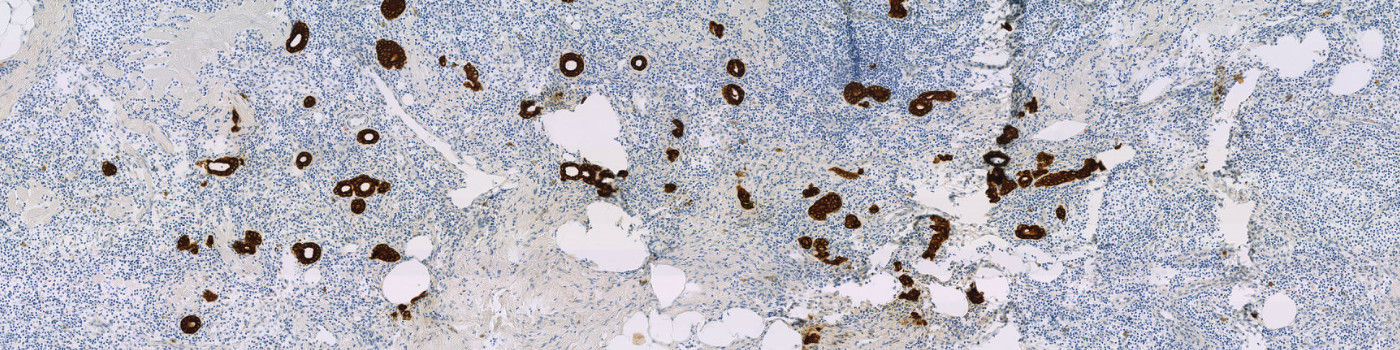 CK, Metastasis Detection