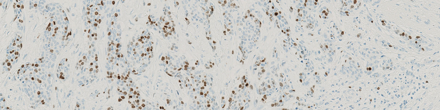 IHC, Tumor Detection, AI