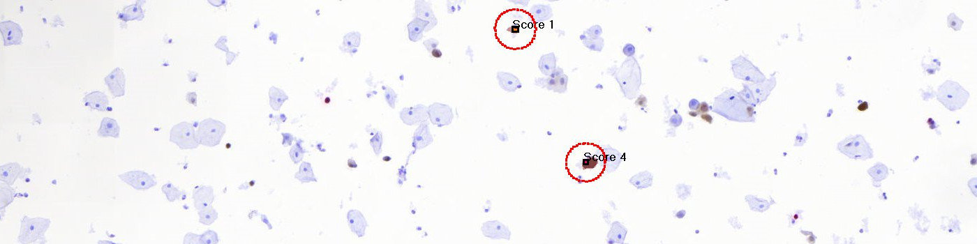 p16+Ki-67, Cervical Cancer, ICC