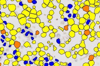 BRAF, Cell Lines, Cancer