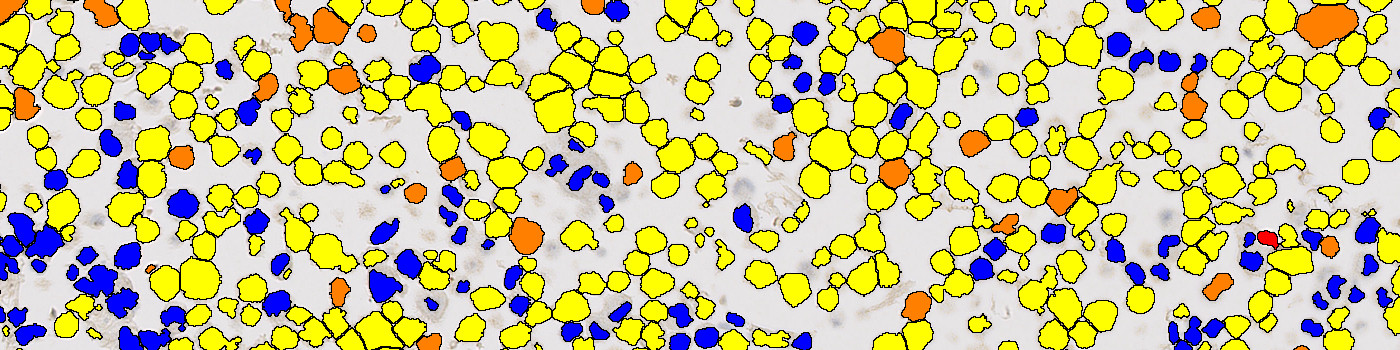 BRAF, Cell Lines, Cancer