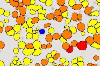 ROS1, Cell Lines, Cancer