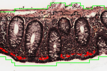 Van Gieson, Collagenous Colitis