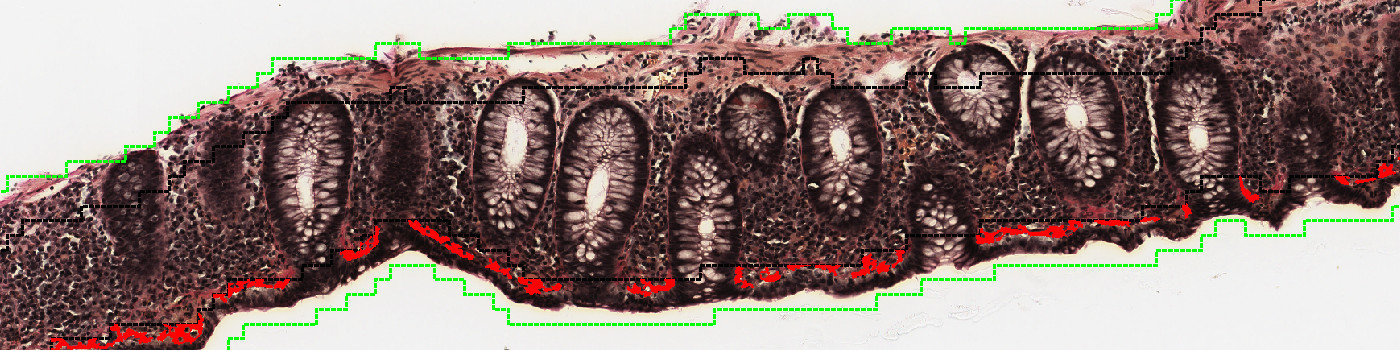 Van Gieson, Collagenous Colitis