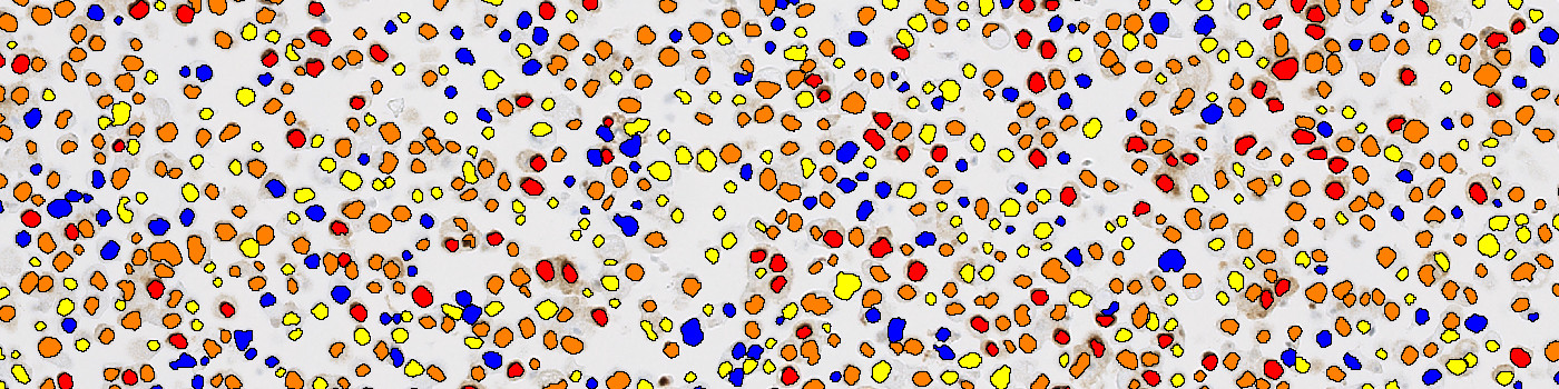 PR, Cell Lines, Cancer