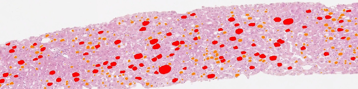 H&E, Liver Steatosis