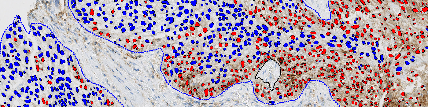 PD-L1, Melanoma, TME