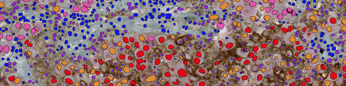 PD-L1+SOX10, Melanoma, TME