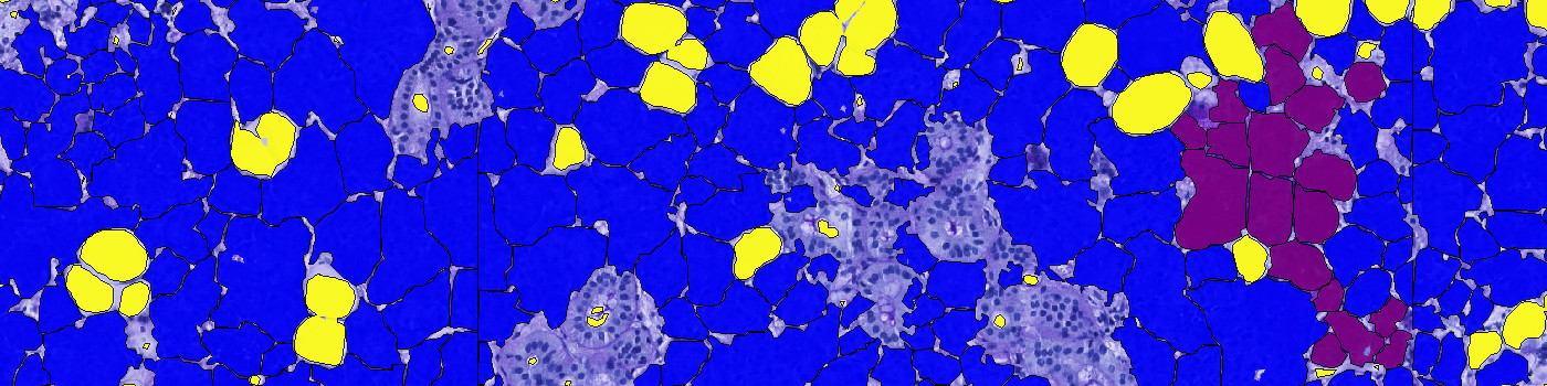 PAS + PCK (VDS), Salivary Gland Tumor