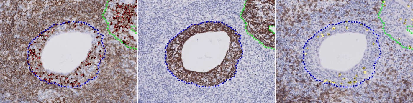 CD3+CD20+CK, Sjögren’s Syndrome