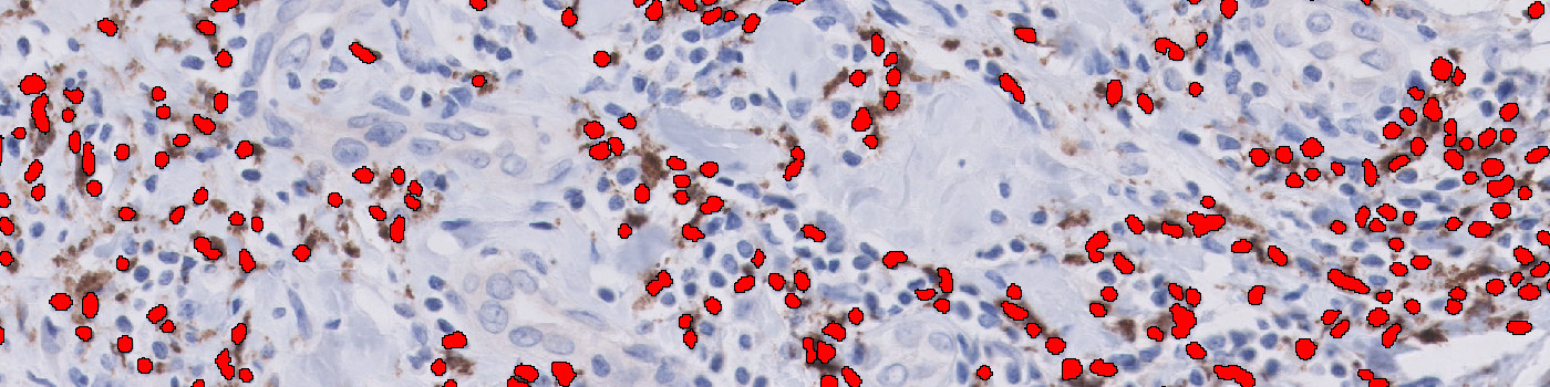 CD68 & CD163, Breast Cancer, TME