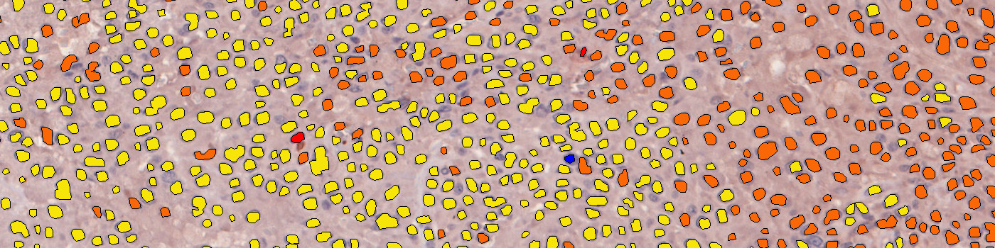 NT, Melanoma, TME