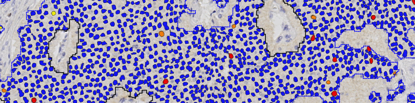 Ki-67, Neuroendocrine Neoplasm