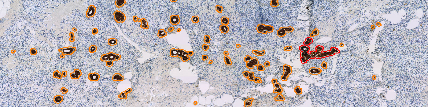 CK, Metastasis Detection