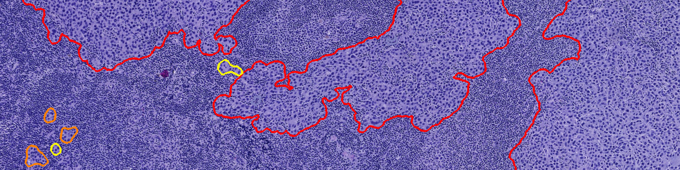 Metastasis Detection, AI