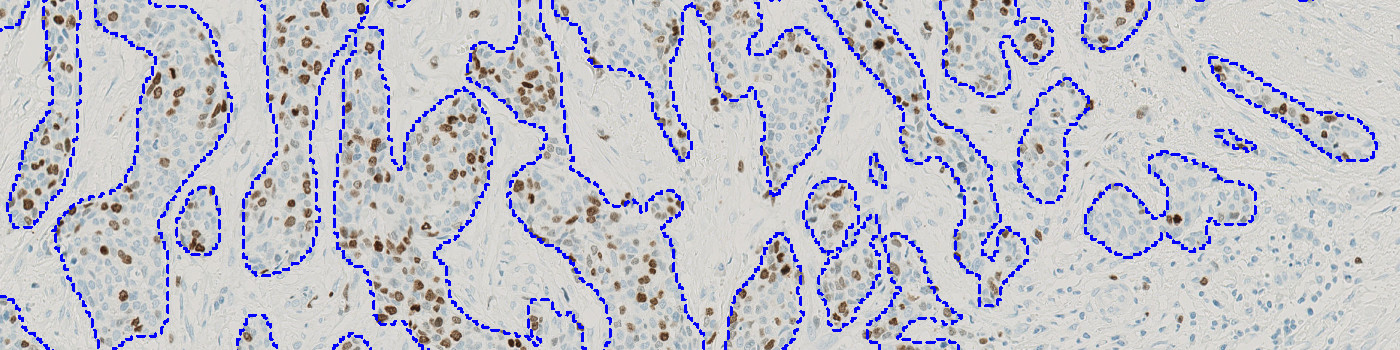 IHC, Tumor Detection, AI