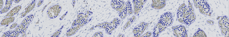 Pathology tissue sample with HER2 IHC stain analyzed with AI biomarker assessment tools.