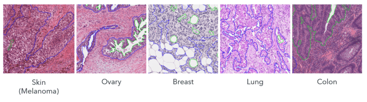Quickstart APPs: H&E Tumor Detection