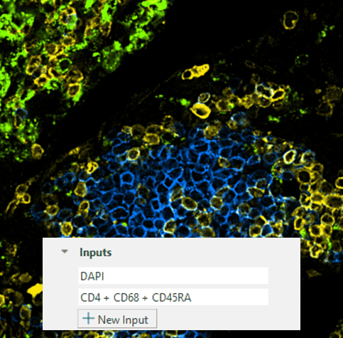 Microscopic tissue analysis with fluorescent markers in Visiopharm platform.
