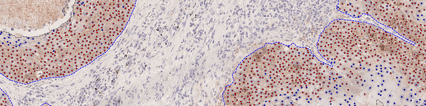 PD-L1 APP, NSCLC 