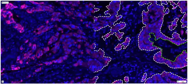 Quickstart APP - Tumor Detection (Fluorescence)