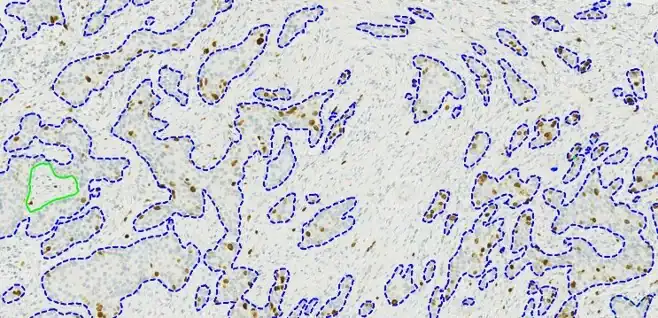 Quickstart APP - IHC Tumor Detection